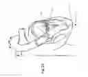 Fig. 16 - Heart valve repair and replacement