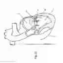 Fig. 17 - Heart valve repair and replacement