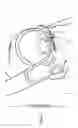Fig. 18 - Heart valve repair and replacement