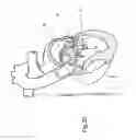 Fig. 25 - Heart valve repair and replacement