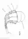 Fig. 26 - Heart valve repair and replacement