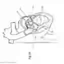 Fig. 28 - Heart valve repair and replacement