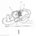 Fig. 29 - Heart valve repair and replacement