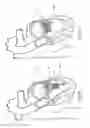 Fig. 30 - Heart valve repair and replacement