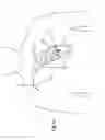 Fig. 34 - Heart valve repair and replacement