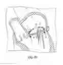 Fig. 45 - Heart valve repair and replacement
