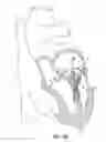 Fig. 51 - Heart valve repair and replacement