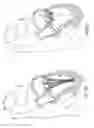 Fig. 52 - Heart valve repair and replacement