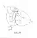 Fig. 13 - Encircling implant delivery systems and methods