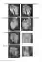 Fig. 14 - Encircling implant delivery systems and methods