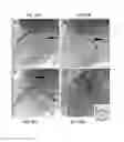 Fig. 17 - Encircling implant delivery systems and methods