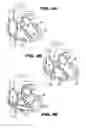 Fig. 05 - Method and device for percutaneous left ventricular reconstruction