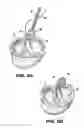 Fig. 08 - Method and device for percutaneous left ventricular reconstruction