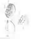 Fig. 08 - Prosthetic articulation surface mounting