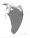 Fig. 22 - Prosthetic articulation surface mounting