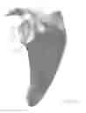 Fig. 23 - Prosthetic articulation surface mounting