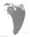 Fig. 25 - Prosthetic articulation surface mounting