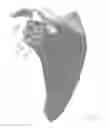 Fig. 26 - Prosthetic articulation surface mounting