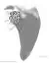 Fig. 27 - Prosthetic articulation surface mounting