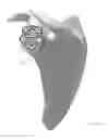 Fig. 28 - Prosthetic articulation surface mounting