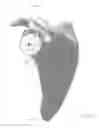 Fig. 29 - Prosthetic articulation surface mounting