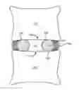 Fig. 01 - Percutaneous implantable nuclear prosthesis