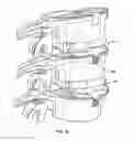 Fig. 14 - Intervertebral disc implant