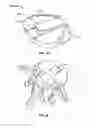 Fig. 17 - Intervertebral disc implant