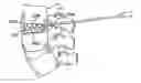 Fig. 01 - Spinal tissue distraction devices