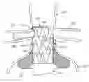 Fig. 01 - Devices and methods for treating aneurysms and other vascular conditions