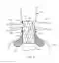 Fig. 03 - Devices and methods for treating aneurysms and other vascular conditions