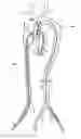 Fig. 01 - Vascular graft device placement methods