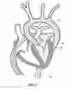Fig. 04 - Vascular graft device placement methods