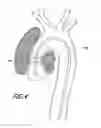 Fig. 06 - Vascular graft device placement methods