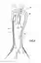 Fig. 08 - Vascular graft device placement methods
