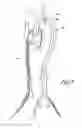 Fig. 09 - Vascular graft device placement methods