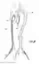Fig. 10 - Vascular graft device placement methods