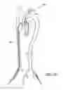 Fig. 12 - Vascular graft device placement methods