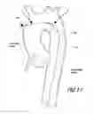 Fig. 14 - Vascular graft device placement methods
