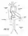 Fig. 15 - Vascular graft device placement methods