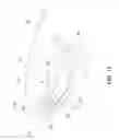 Fig. 15 - Elbow orthosis