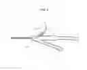 Fig. 05 - Catheter of infection protective structure for insertion into urethra of child