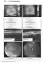 Fig. 09 - USE OF PEDF IN AN ENCAPSULATED CELL-BASED DELIVERY SYSTEM