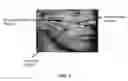 Fig. 02 - Method for improving duration of effect of dermal filler treatment