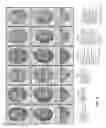 Fig. 03 - Method for improving duration of effect of dermal filler treatment