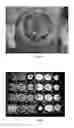 Fig. 11 - Pharmaceutical compositions for treating thermal injuries and wounds combined with bone injuries