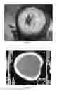 Fig. 12 - Pharmaceutical compositions for treating thermal injuries and wounds combined with bone injuries