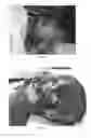 Fig. 14 - Pharmaceutical compositions for treating thermal injuries and wounds combined with bone injuries