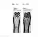 Fig. 11 - Systemic and local ex vivo gene therapy of the skeleton