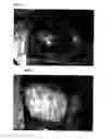 Fig. 04 - Antiadhesive Kit and Method of Adhesion Prevention